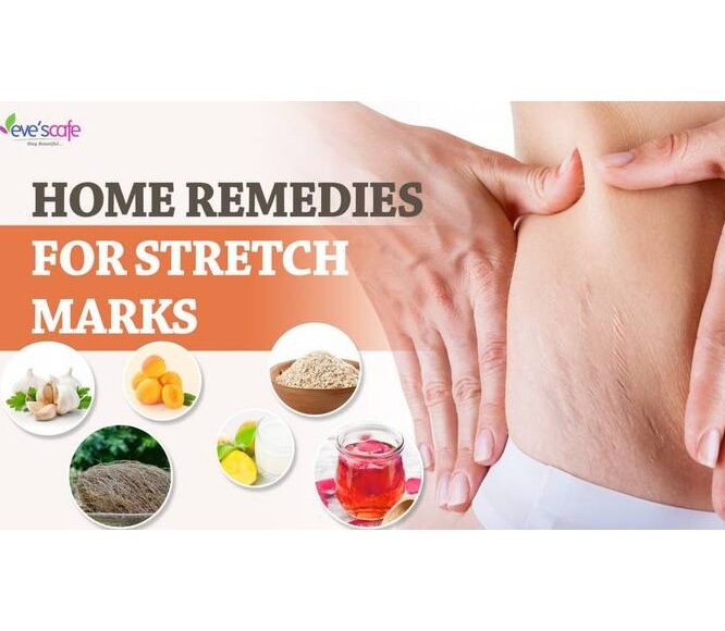 Evescafe | DIY - Home Remedies for Stretch Marks | Get Rid of Stretch Marks after Pregnancy