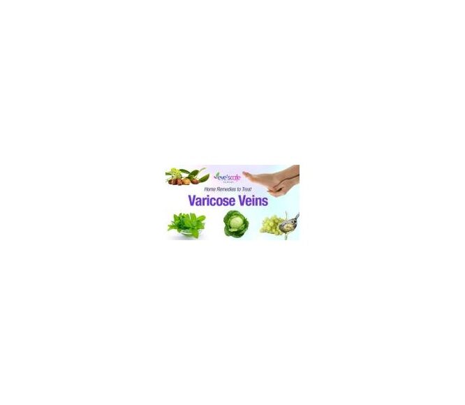 Natural Home Remedies to Cure Varicose Veins