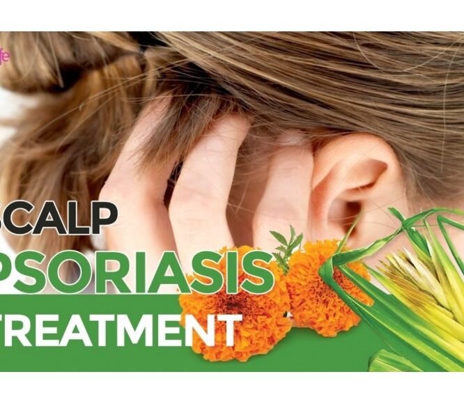 SCALP PSORIASIS OIL | CURE PSORIASIS QUICKLY