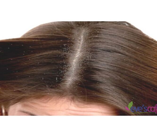 What causes Dandruff